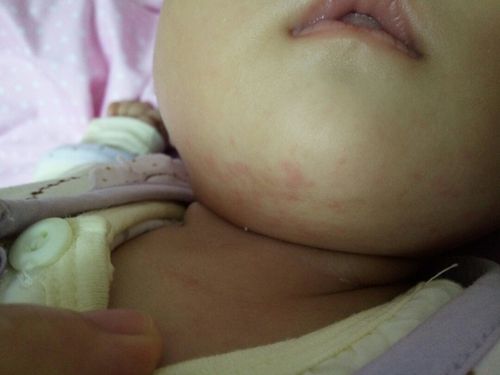 宝贝下巴张满了密密麻麻的小红疙瘩,是奶藓吗,为什么抹药也没好