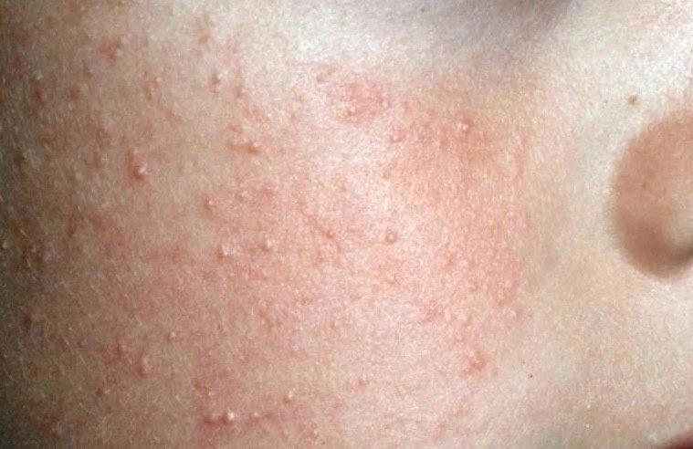 毛周角化(鸡皮肤)的治疗