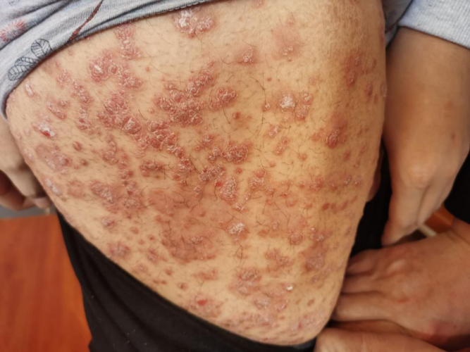 银屑病血热论之误