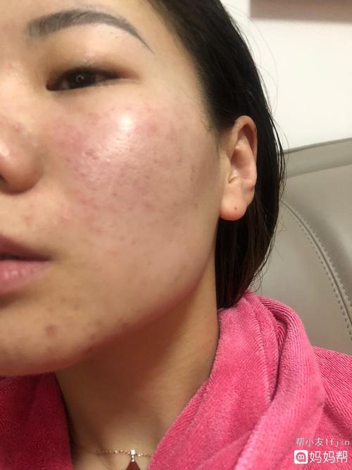 有没有怀孕早期脸上湿疹,过敏的,又红又痒