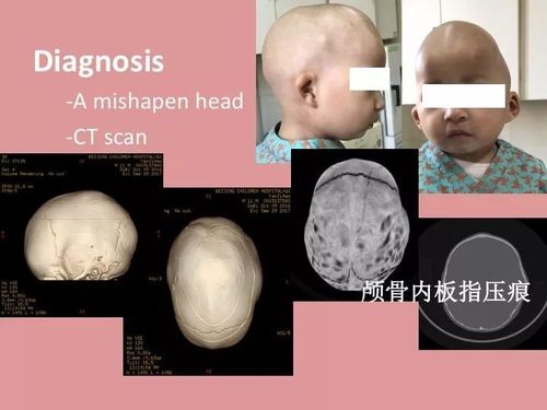 [课件]儿童颅缝早闭的手术治疗进展及内镜辅助下治疗-金炤延 | 王刚