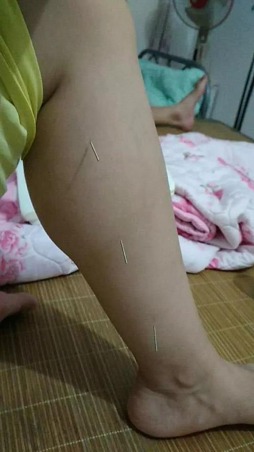 手把手教会你针灸治痛风