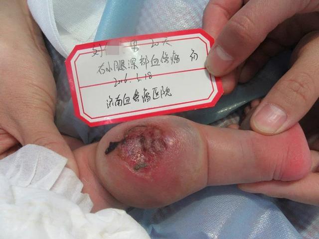 口腔,肛门生殖区域的血管瘤易形成溃疡.