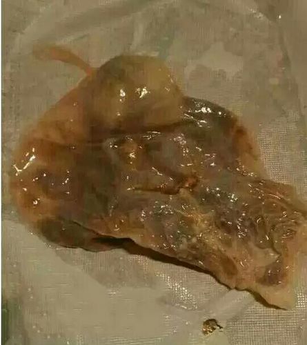 保妇康栓,克霉唑阴道片,消糜栓,洁尔阴,妇炎洁,中枪的请举手!