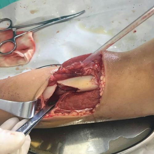 ▼术中经清创及骨折复位后,见胫骨缺了个大窟窿!