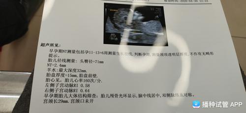 [试管婴儿]nt值2.4mm正常吗?玻璃心