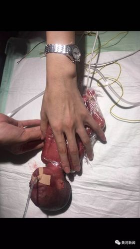 山西省儿童医院:罕见!我省成功救治一名胎龄24周胎儿