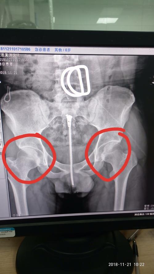 我的髋关节窝有什么问题吗