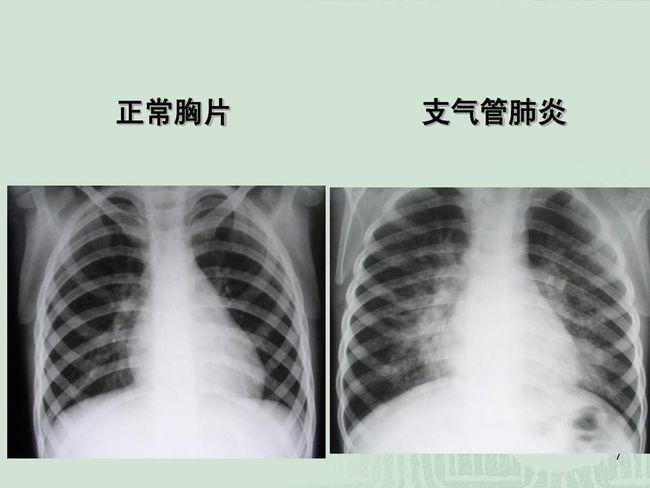 判断孩子是否为肺炎一定要拍胸片吗