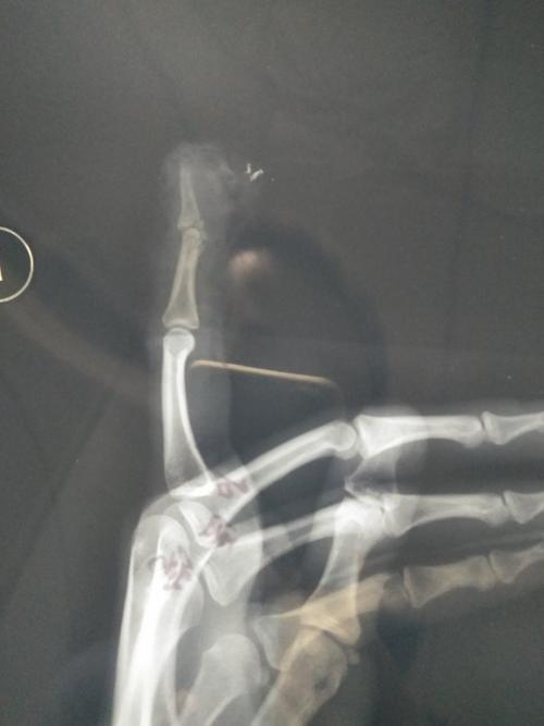 女,30岁左手指被断一截,如果做工商鉴定能评几级,附ct