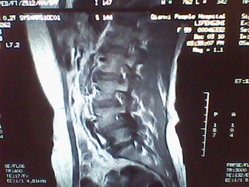 第四腰椎一度滑脱