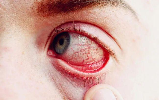 孩子眼睛红又肿眼屎黄又多可不是上火这么简单