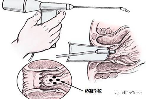 适用于一,二和三期的痔疮,可能比硬化剂注射更有效.