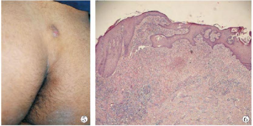 肿物上端可见针眼样皮肤破口; 图 6炎症肉芽肿(he × 200)诊断骶尾部