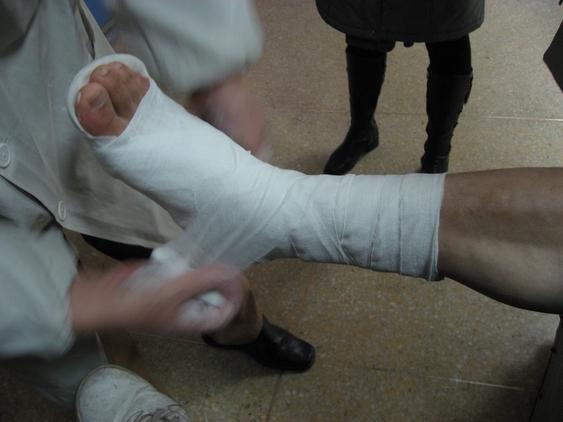 腿骨折打石膏图片_脚趾骨裂打石膏图片_左手骨折打石膏图片