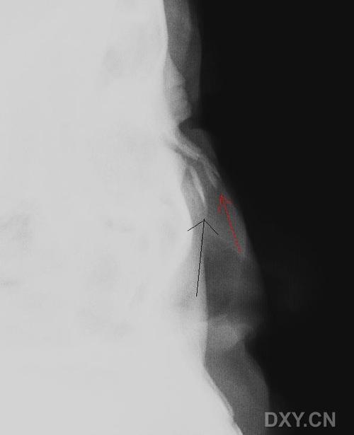 【请教】鼻骨外伤x线侧位片