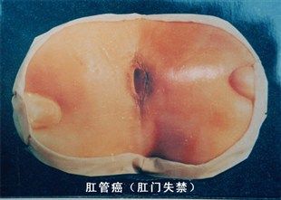    肛管癌(肛门失禁)