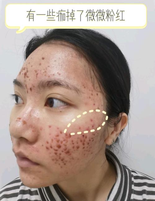 这个痘坑朋友非常乐意分享她的恢复情况,发了几张恢复