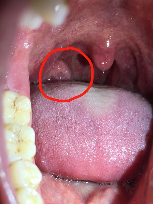 28岁,右侧扁桃体肿大应该吃什么药?没发烧.