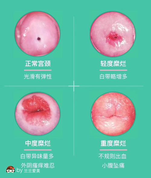 科普宫颈糜烂