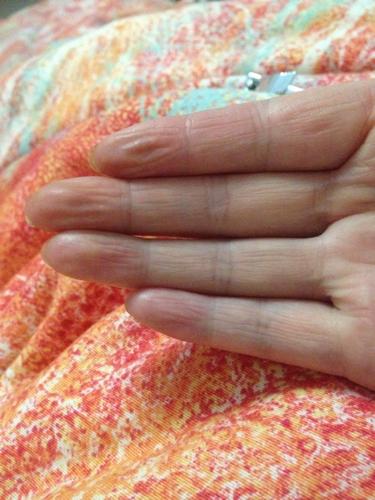 手上老是感觉干,而且出来竖纹两个月了,是人体缺水?缺