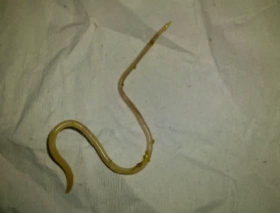 孩子半夜挠屁股,挠出好几条白色的小虫子,就诊后医生说不是蛔虫!