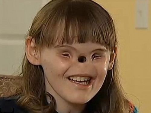 ">北卡罗来纳州 /a>的一名女孩天生患有一种罕见疾病:没有眼睛和鼻子