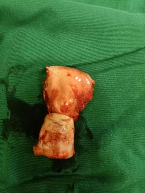 患者既往患有高血压病,心脏病;入院诊断:子宫脱垂3度,阴