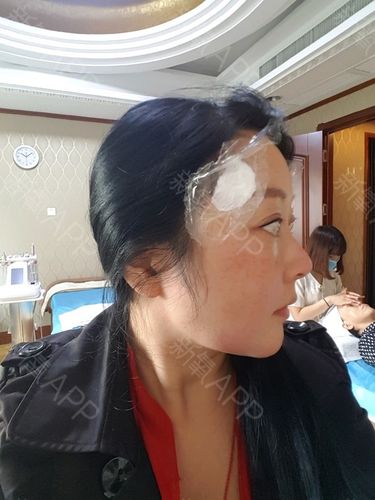 我在壹美整形美容医院 ,多次注射爱付莱玻尿酸.