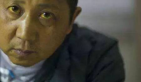 大哥,你的脸色晦暗发黄,黑眼圈重,皮肤干燥无光泽,是典型的"肝病面容"