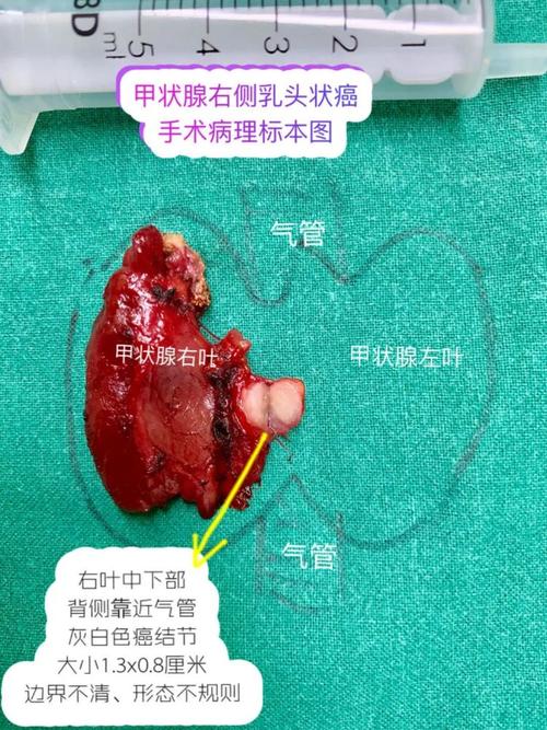 要警惕紧邻气管及喉返神经的甲状腺癌的危害!
