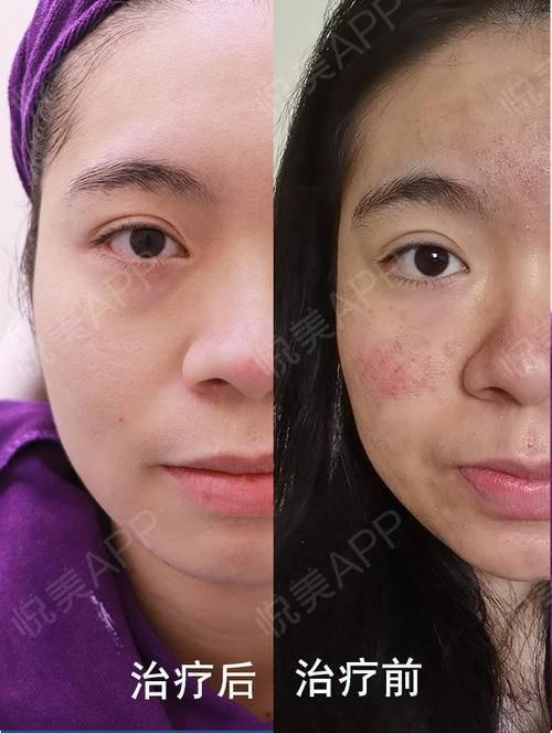 大家看看光子嫩肤效果咋样,含对比图