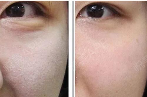 看了水光针效果图前后对比才知道水光针原来是这么回