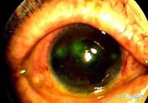 教你患有角膜炎以后如何正确的面对快速康复