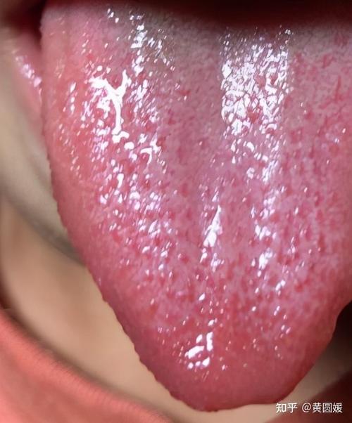第一张图,舌质红,小红点多,草莓舌,热重 舌红的孩子,可以选择清天河