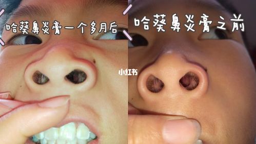 儿童鼻甲肥大_儿童鼻炎_母婴_育儿经验