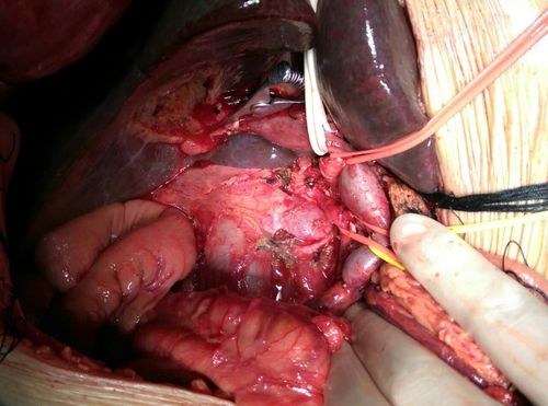 动脉优先胰十二指肠切除治疗胰腺勾突癌 (原创)