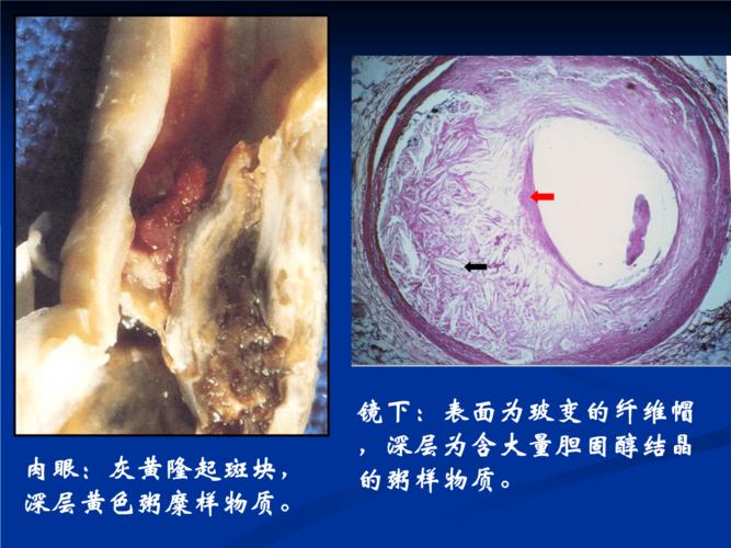粥样斑块纤维帽脂质核动脉粥样硬化ppt86页