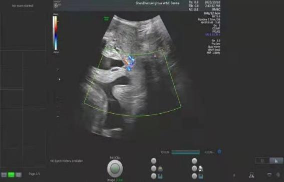 怀孕5个多月胎儿差点"掉"出来?只因那里没扎紧,孕妈们小心了!