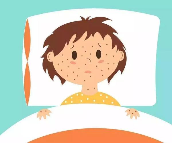 水痘进入高发期,这些"战痘"知识你不能不知