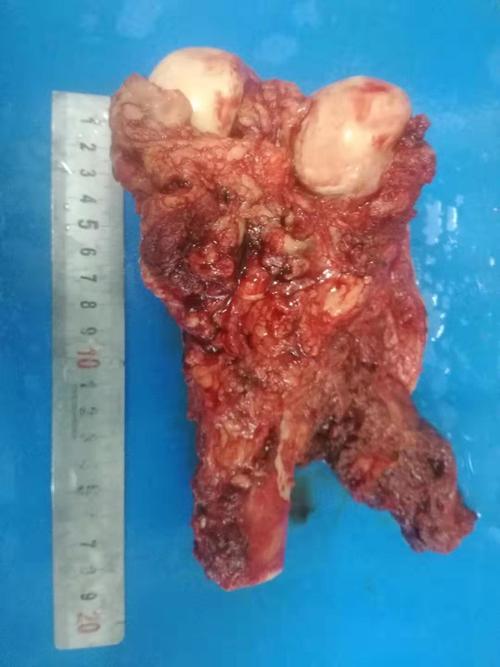 恶性骨肉瘤!大范围浸润!骨科团队精准医治!