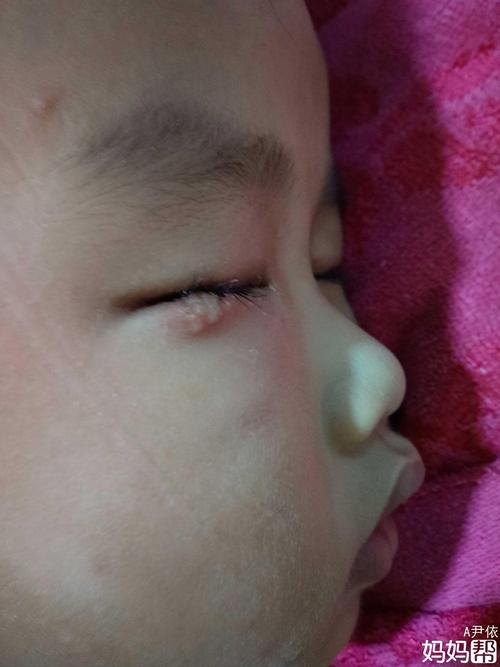宝宝眼睛总长疱疹怎么办?求助