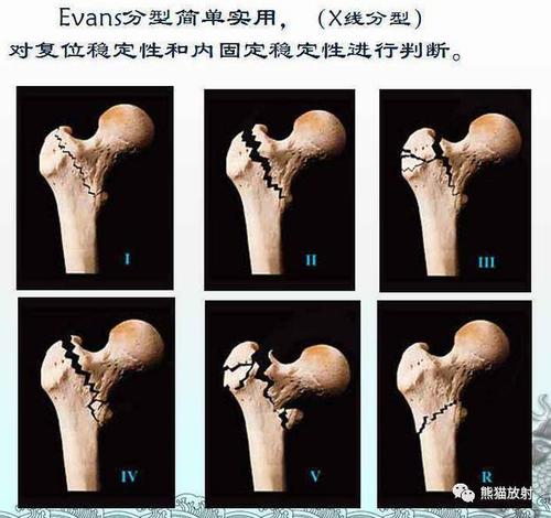 四肢骨折分型大全