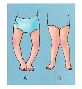 孩子出现x,o型腿,爸妈不要慌!这么做能帮助孩子矫正!