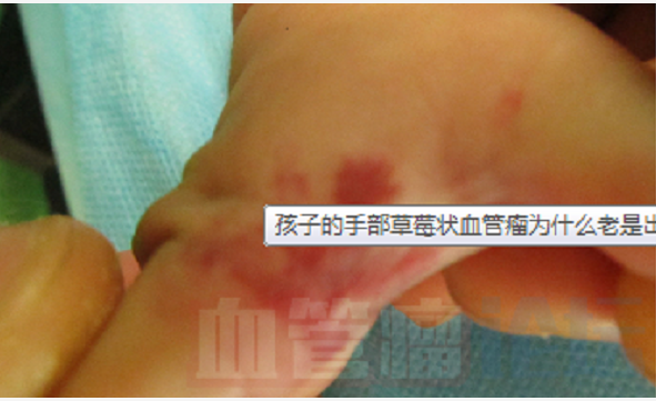 孩子的手部草莓状血管瘤为什么老是出血?