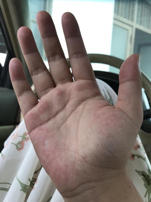 这样的手掌 正常嘛?