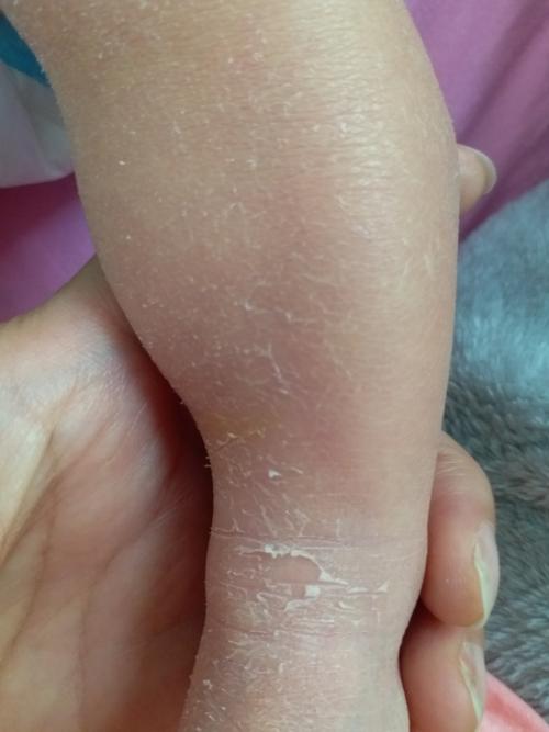 宝宝身上这个是宝宝换胎皮吗?