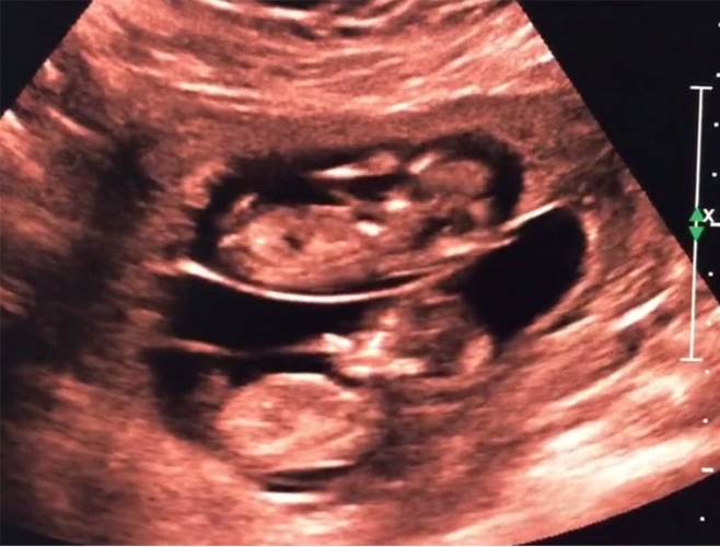 孕妇去做彩超,看到双胞胎是这样的"姿势",网友直呼:神奇!