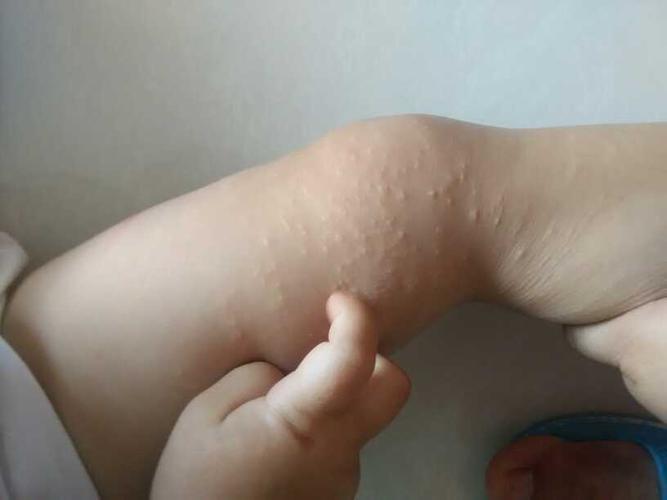 宝贝得的到底是沙土皮炎,还是湿疹