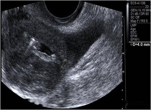 超声典型病例子宫穿孔